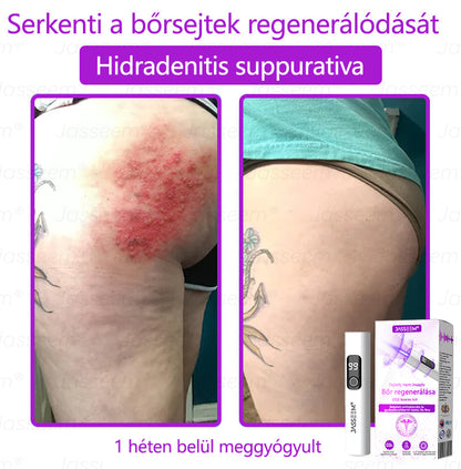 𝐉𝐚𝐬𝐬𝐞𝐞𝐦® Fejlett, nem invazív bőrjavító CO₂ lézeres toll 🛫 (Gyengéden eltávolítja a szemölcsöket, anyajegyeket, öregségi foltokat és bőrkinövéseket – fájdalom és gond nélkül!)🔥🔥