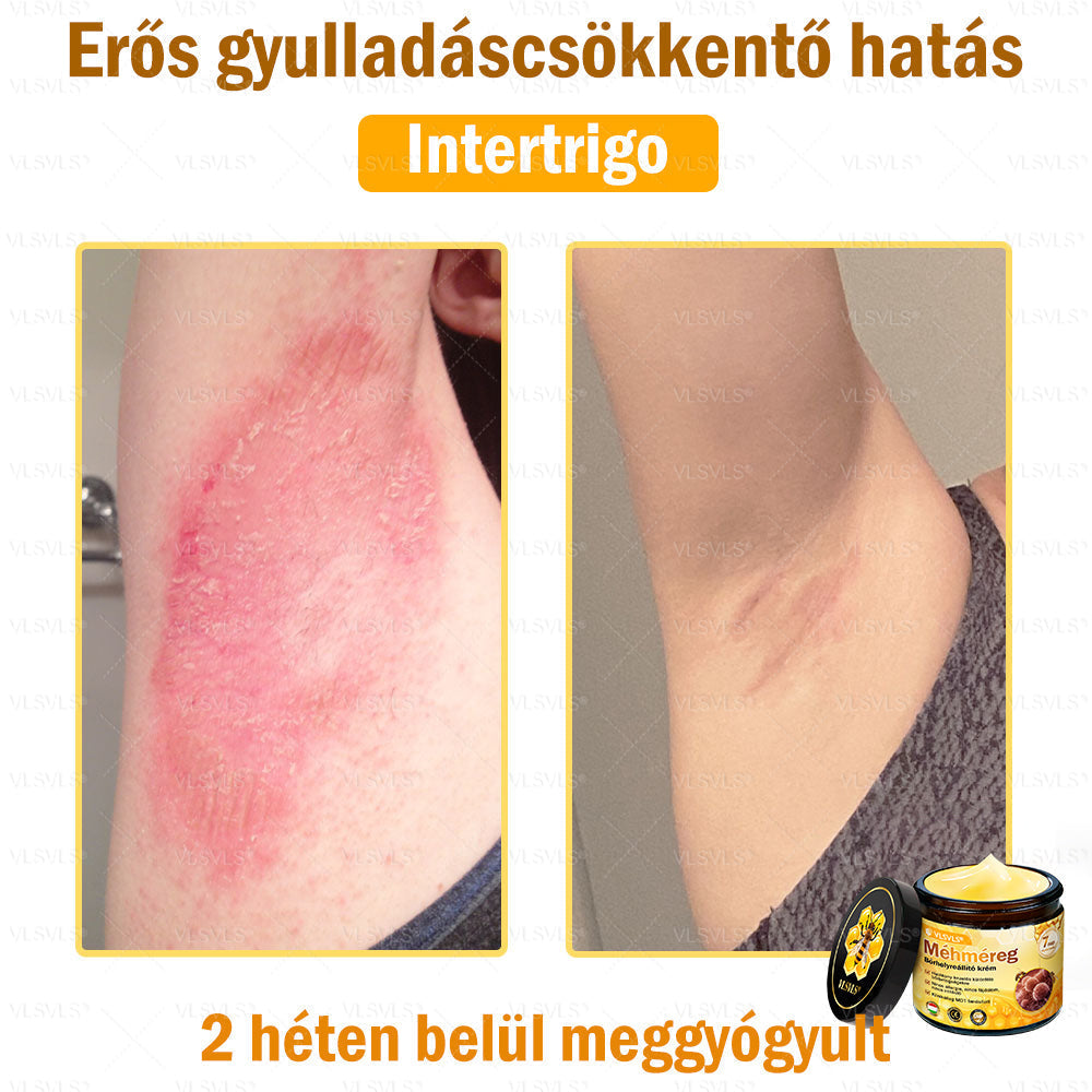 VLSVLS® Méhméreg Bőrhelyreállító Krém (👨‍⚕‍CE jóváhagyott)👍✅✅