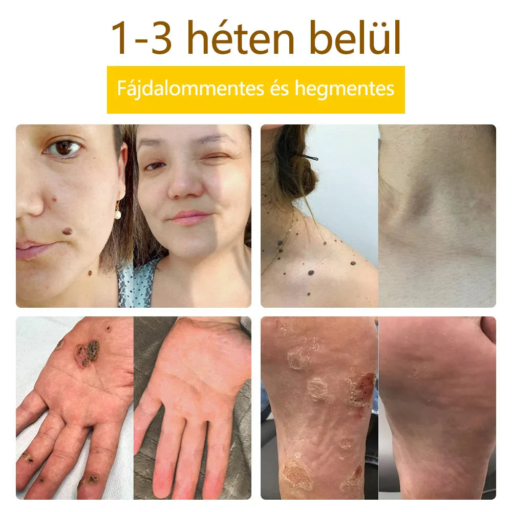 ✅flysmus™ méhméreg kezelő krém🐝: Ekcéma, pikkelysömör, akne, rosacea, gombás fertőzések, szemölcsök kezelése🐝🐝