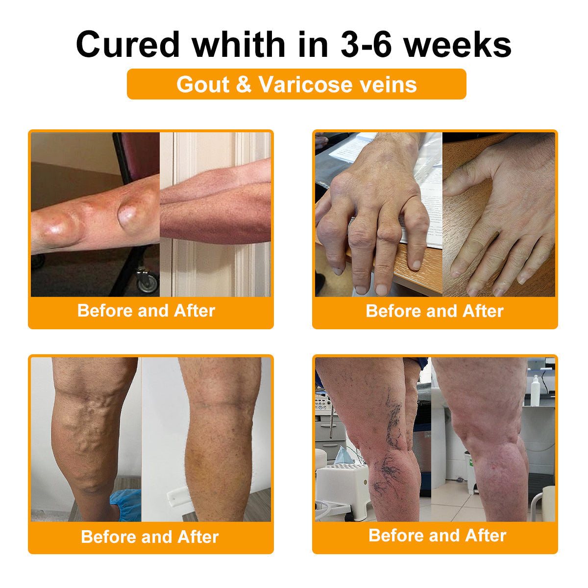 🦴TLOPA® Botulinum Toxin és Méhméreg Fájdalomcsillapító Csontgyógyító Krém🐝 🔥(Kifejezetten időseknek & ortopéd szakorvosok ajánlásával)🦴