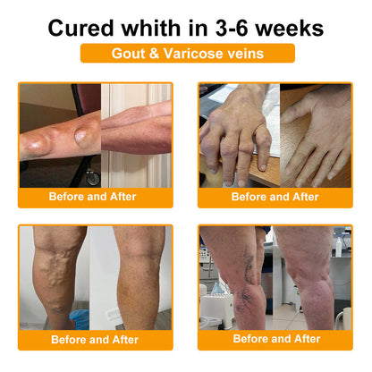 🦴TLOPA® Botulinum Toxin és Méhméreg Fájdalomcsillapító Csontgyógyító Krém🐝 🔥(Kifejezetten időseknek & ortopéd szakorvosok ajánlásával)🦴