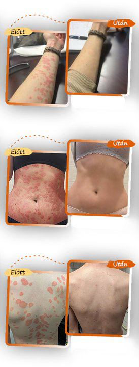 ✅ Zvoevo® Fekete Rizses Bőrregeneráló Krém 👨‍⚕️ (Szemölcsök, bőrkinövések, foltok és hiperpigmentáció kezelésére)✅