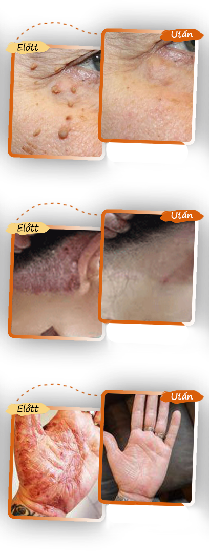 ✅ Zvoevo® Fekete Rizses Bőrregeneráló Krém 👨‍⚕️ (Szemölcsök, bőrkinövések, foltok és hiperpigmentáció kezelésére)✅