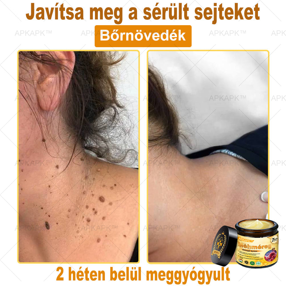 𝐀𝐏𝐊𝐀𝐏𝐊™ 𝐌É𝐇𝐌É𝐑𝐄𝐆 Á𝐓𝐅𝐎𝐆Ó 𝐊𝐑É𝐌🥇🥇𝐀 𝐛ö𝐫𝐩𝐫𝐨𝐛𝐥é𝐦á𝐤 𝐤𝐞𝐳𝐞𝐥é𝐬𝐞 𝐦𝐚𝐠á𝐛𝐚𝐧 𝐟𝐨𝐠𝐥𝐚𝐥𝐣𝐚: é𝐥𝐞𝐭𝐤𝐨𝐫𝐢 𝐟𝐨𝐥𝐭𝐨𝐤, 𝐡𝐞𝐠𝐞𝐤, 𝐬𝐳𝐞𝐦ö𝐥𝐜𝐬ö𝐤, 𝐛ö𝐫𝐧ö𝐯𝐞𝐝é𝐤𝐞𝐤, 𝐭á𝐥𝐲𝐨𝐠𝐨𝐤, 𝐩𝐚𝐭𝐭𝐚𝐧á𝐬𝐨𝐤, 𝐞𝐤𝐜é𝐦𝐚, 𝐩𝐬𝐨𝐫𝐢𝐚𝐬𝐢𝐬, 𝐚𝐜𝐧𝐞 𝐢𝐧𝐯𝐞𝐫𝐬𝐚, 𝐫á𝐧𝐜𝐨𝐤, 𝐛ö𝐫ö𝐫𝐞𝐠𝐞𝐝é𝐬 é𝐬 𝐞𝐠𝐲é𝐛 𝐩𝐫𝐨𝐛𝐥é𝐦á𝐤🔥🔥