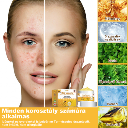 🏵️Vsoxa™ méhméreg szemölcs és anyajegy eltávolító krém (Utolsó napi akció, 80% kedvezmény)🌷