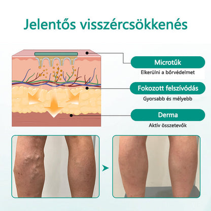 Cvreoz® LegRenew visszér tapasz javítja a vénák egészségét és megszünteti a visszereket🌿Nincs tű, nincs műtét, csak biztonságos, gyengéd és hatékony eredmény✨✨