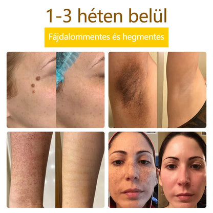 ✅flysmus™ méhméreg kezelő krém🐝: Ekcéma, pikkelysömör, akne, rosacea, gombás fertőzések, szemölcsök kezelése🐝🐝