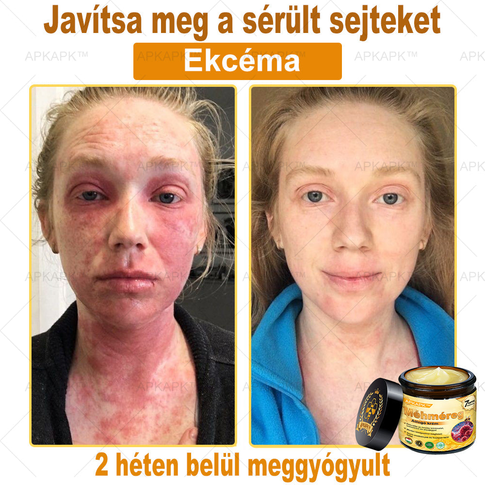 𝐀𝐏𝐊𝐀𝐏𝐊™ 𝐌É𝐇𝐌É𝐑𝐄𝐆 Á𝐓𝐅𝐎𝐆Ó 𝐊𝐑É𝐌🥇🥇𝐀 𝐛ö𝐫𝐩𝐫𝐨𝐛𝐥é𝐦á𝐤 𝐤𝐞𝐳𝐞𝐥é𝐬𝐞 𝐦𝐚𝐠á𝐛𝐚𝐧 𝐟𝐨𝐠𝐥𝐚𝐥𝐣𝐚: é𝐥𝐞𝐭𝐤𝐨𝐫𝐢 𝐟𝐨𝐥𝐭𝐨𝐤, 𝐡𝐞𝐠𝐞𝐤, 𝐬𝐳𝐞𝐦ö𝐥𝐜𝐬ö𝐤, 𝐛ö𝐫𝐧ö𝐯𝐞𝐝é𝐤𝐞𝐤, 𝐭á𝐥𝐲𝐨𝐠𝐨𝐤, 𝐩𝐚𝐭𝐭𝐚𝐧á𝐬𝐨𝐤, 𝐞𝐤𝐜é𝐦𝐚, 𝐩𝐬𝐨𝐫𝐢𝐚𝐬𝐢𝐬, 𝐚𝐜𝐧𝐞 𝐢𝐧𝐯𝐞𝐫𝐬𝐚, 𝐫á𝐧𝐜𝐨𝐤, 𝐛ö𝐫ö𝐫𝐞𝐠𝐞𝐝é𝐬 é𝐬 𝐞𝐠𝐲é𝐛 𝐩𝐫𝐨𝐛𝐥é𝐦á𝐤🔥🔥