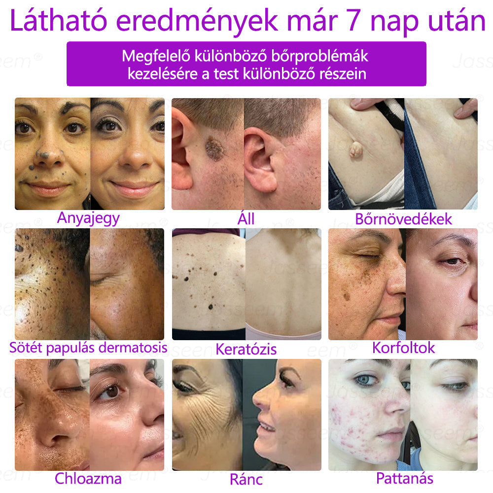 𝐉𝐚𝐬𝐬𝐞𝐞𝐦® Fejlett, nem invazív bőrjavító CO₂ lézeres toll 🛫 (Gyengéden eltávolítja a szemölcsöket, anyajegyeket, öregségi foltokat és bőrkinövéseket – fájdalom és gond nélkül!)🔥🔥