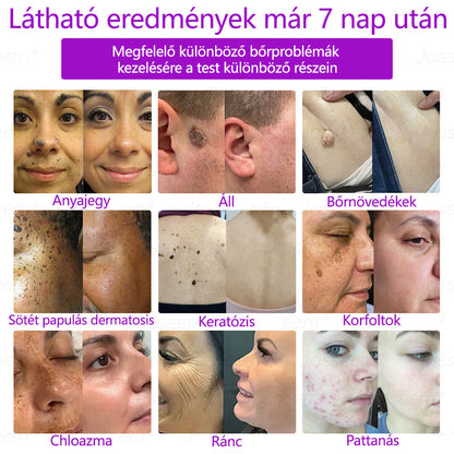 𝐉𝐚𝐬𝐬𝐞𝐞𝐦® Fejlett, nem invazív bőrjavító CO₂ lézeres toll 🛫 (Gyengéden eltávolítja a szemölcsöket, anyajegyeket, öregségi foltokat és bőrkinövéseket – fájdalom és gond nélkül!)🔥🔥