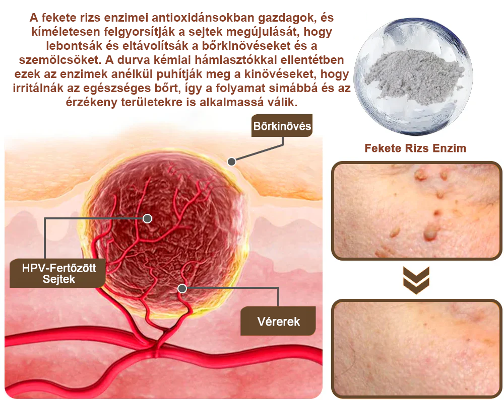 ✅ Zvoevo® Fekete Rizses Bőrregeneráló Krém 👨‍⚕️ (Szemölcsök, bőrkinövések, foltok és hiperpigmentáció kezelésére)✅