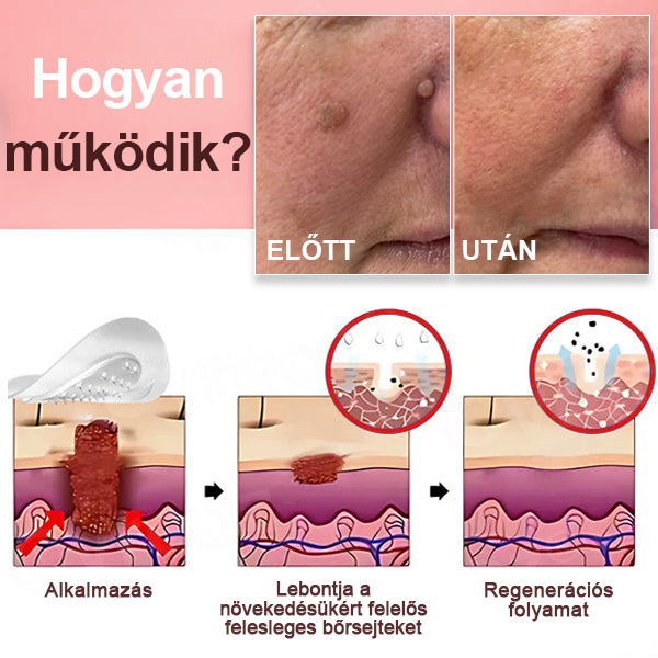 KUBOZN® Nano-mikrotűs bőrcímke-eltávolító tapaszok✨✨✨