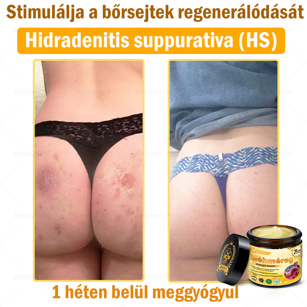 𝐀𝐏𝐊𝐀𝐏𝐊™ 𝐌É𝐇𝐌É𝐑𝐄𝐆 Á𝐓𝐅𝐎𝐆Ó 𝐊𝐑É𝐌🥇🥇𝐀 𝐛ö𝐫𝐩𝐫𝐨𝐛𝐥é𝐦á𝐤 𝐤𝐞𝐳𝐞𝐥é𝐬𝐞 𝐦𝐚𝐠á𝐛𝐚𝐧 𝐟𝐨𝐠𝐥𝐚𝐥𝐣𝐚: é𝐥𝐞𝐭𝐤𝐨𝐫𝐢 𝐟𝐨𝐥𝐭𝐨𝐤, 𝐡𝐞𝐠𝐞𝐤, 𝐬𝐳𝐞𝐦ö𝐥𝐜𝐬ö𝐤, 𝐛ö𝐫𝐧ö𝐯𝐞𝐝é𝐤𝐞𝐤, 𝐭á𝐥𝐲𝐨𝐠𝐨𝐤, 𝐩𝐚𝐭𝐭𝐚𝐧á𝐬𝐨𝐤, 𝐞𝐤𝐜é𝐦𝐚, 𝐩𝐬𝐨𝐫𝐢𝐚𝐬𝐢𝐬, 𝐚𝐜𝐧𝐞 𝐢𝐧𝐯𝐞𝐫𝐬𝐚, 𝐫á𝐧𝐜𝐨𝐤, 𝐛ö𝐫ö𝐫𝐞𝐠𝐞𝐝é𝐬 é𝐬 𝐞𝐠𝐲é𝐛 𝐩𝐫𝐨𝐛𝐥é𝐦á𝐤🔥🔥