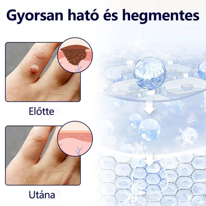 Timilk® WartErase – Fagyasztó Szemölcseltávolító Spray❄️