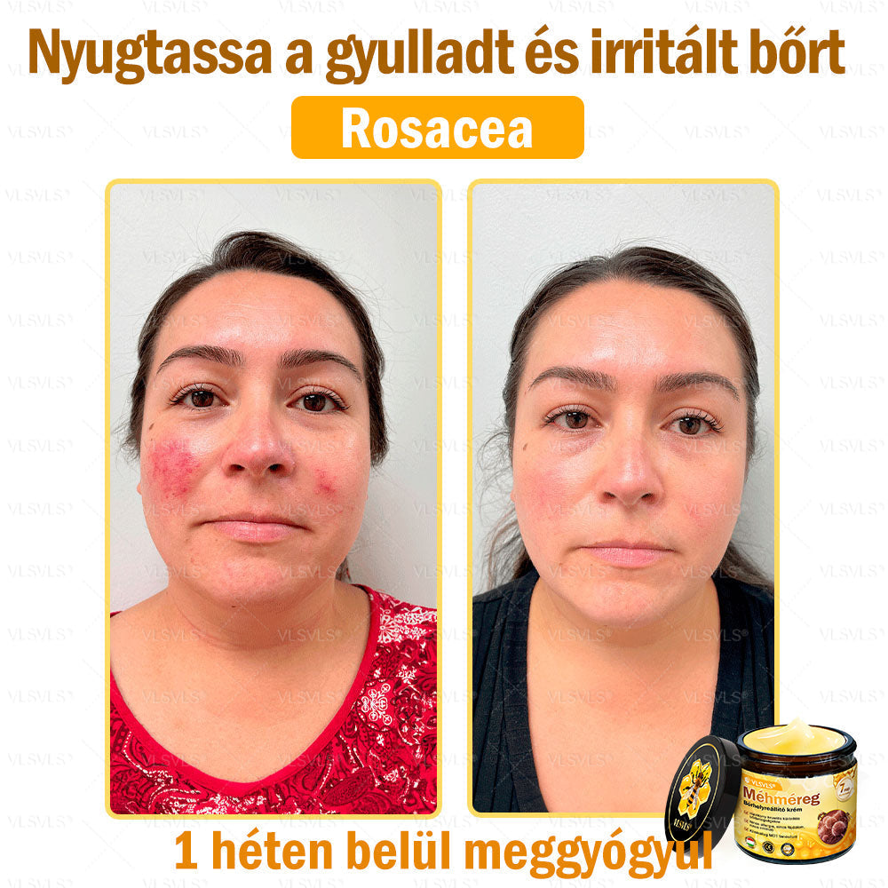 VLSVLS® Méhméreg Bőrhelyreállító Krém (👨‍⚕‍CE jóváhagyott)👍✅✅