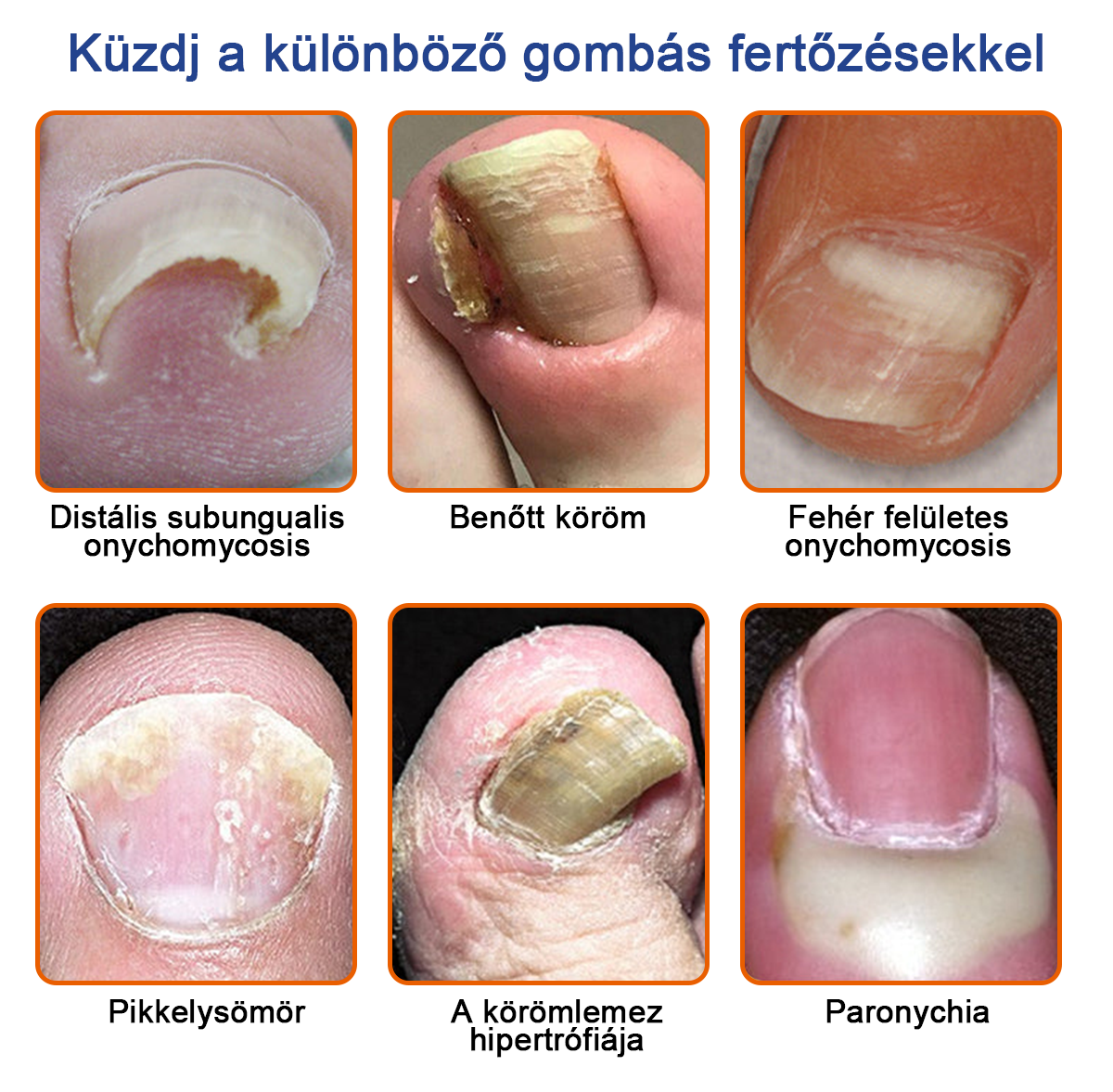👣🐝🐝Furzero™ Méhméreg Körömgomba Kezelőoldat: Teljes megoldás a körömgomba problémájára🌟👣🐝👣