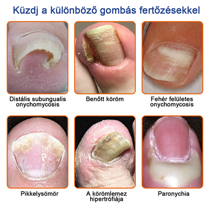 👣🐝🐝Furzero™ Méhméreg Körömgomba Kezelőoldat: Teljes megoldás a körömgomba problémájára🌟👣🐝👣