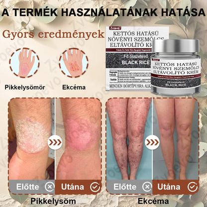 ✅ Zvoevo® Fekete Rizses Bőrregeneráló Krém 👨‍⚕️ (Szemölcsök, bőrkinövések, foltok és hiperpigmentáció kezelésére)✅