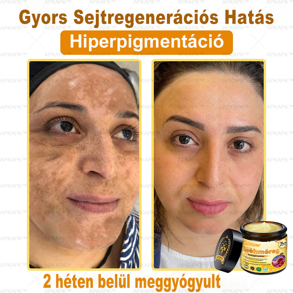 𝐀𝐏𝐊𝐀𝐏𝐊™ 𝐌É𝐇𝐌É𝐑𝐄𝐆 Á𝐓𝐅𝐎𝐆Ó 𝐊𝐑É𝐌🥇🥇𝐀 𝐛ö𝐫𝐩𝐫𝐨𝐛𝐥é𝐦á𝐤 𝐤𝐞𝐳𝐞𝐥é𝐬𝐞 𝐦𝐚𝐠á𝐛𝐚𝐧 𝐟𝐨𝐠𝐥𝐚𝐥𝐣𝐚: é𝐥𝐞𝐭𝐤𝐨𝐫𝐢 𝐟𝐨𝐥𝐭𝐨𝐤, 𝐡𝐞𝐠𝐞𝐤, 𝐬𝐳𝐞𝐦ö𝐥𝐜𝐬ö𝐤, 𝐛ö𝐫𝐧ö𝐯𝐞𝐝é𝐤𝐞𝐤, 𝐭á𝐥𝐲𝐨𝐠𝐨𝐤, 𝐩𝐚𝐭𝐭𝐚𝐧á𝐬𝐨𝐤, 𝐞𝐤𝐜é𝐦𝐚, 𝐩𝐬𝐨𝐫𝐢𝐚𝐬𝐢𝐬, 𝐚𝐜𝐧𝐞 𝐢𝐧𝐯𝐞𝐫𝐬𝐚, 𝐫á𝐧𝐜𝐨𝐤, 𝐛ö𝐫ö𝐫𝐞𝐠𝐞𝐝é𝐬 é𝐬 𝐞𝐠𝐲é𝐛 𝐩𝐫𝐨𝐛𝐥é𝐦á𝐤🔥🔥