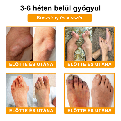 🦴TLOPA® Botulinum Toxin és Méhméreg Fájdalomcsillapító Csontgyógyító Krém🐝 🔥(Kifejezetten időseknek & ortopéd szakorvosok ajánlásával)🦴