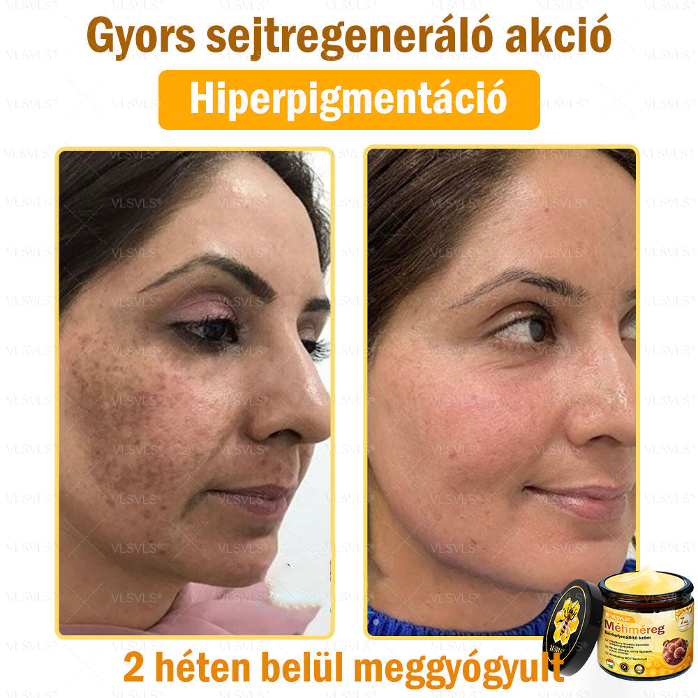 VLSVLS® Méhméreg Bőrhelyreállító Krém (👨‍⚕‍CE jóváhagyott)👍✅✅