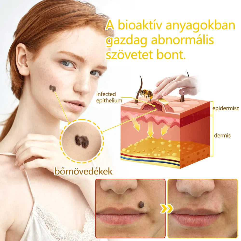 ✅flysmus™ méhméreg kezelő krém🐝: Ekcéma, pikkelysömör, akne, rosacea, gombás fertőzések, szemölcsök kezelése🐝🐝