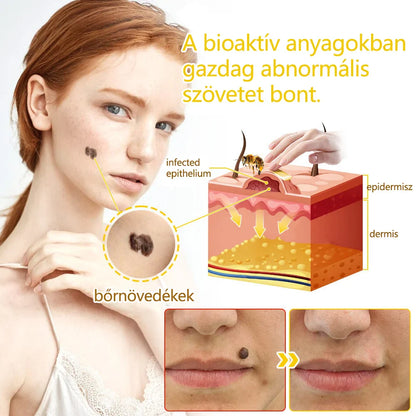 ✅flysmus™ méhméreg kezelő krém🐝: Ekcéma, pikkelysömör, akne, rosacea, gombás fertőzések, szemölcsök kezelése🐝🐝