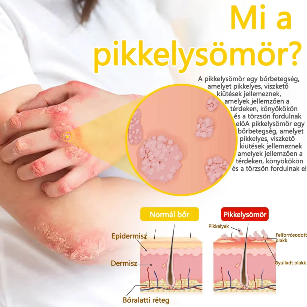✅flysmus™ méhméreg kezelő krém🐝: Ekcéma, pikkelysömör, akne, rosacea, gombás fertőzések, szemölcsök kezelése🐝🐝