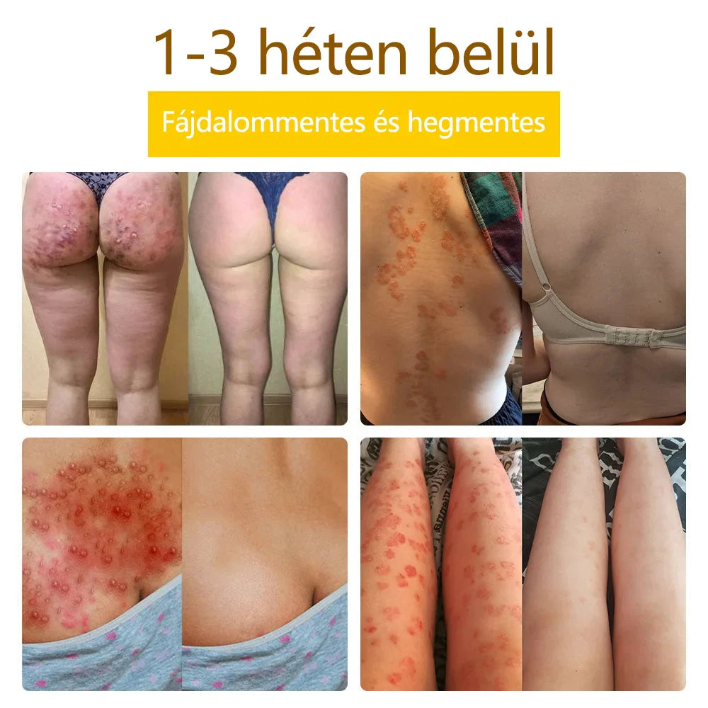 ✅flysmus™ méhméreg kezelő krém🐝: Ekcéma, pikkelysömör, akne, rosacea, gombás fertőzések, szemölcsök kezelése🐝🐝