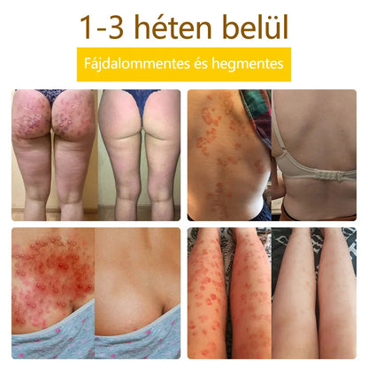 ✅flysmus™ méhméreg kezelő krém🐝: Ekcéma, pikkelysömör, akne, rosacea, gombás fertőzések, szemölcsök kezelése🐝🐝